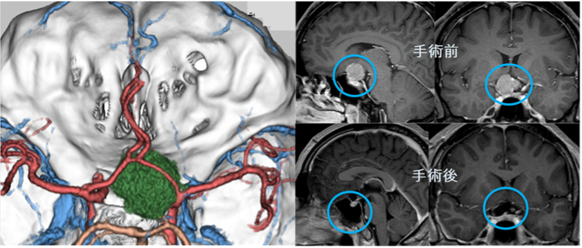 手術前と後のMRIの画像