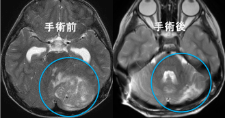 小児脳腫瘍（髄芽腫）