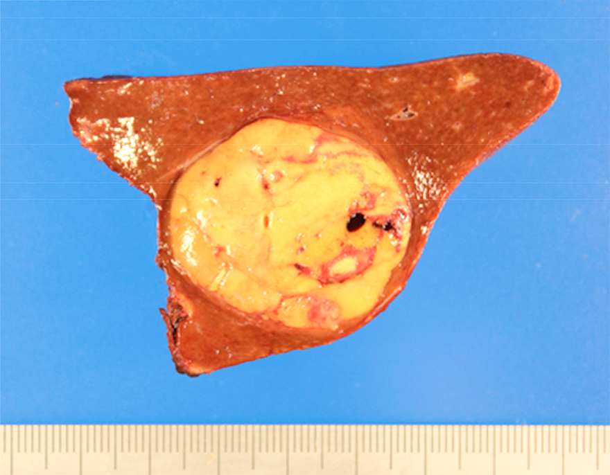 写真1 肝臓がん 細胞