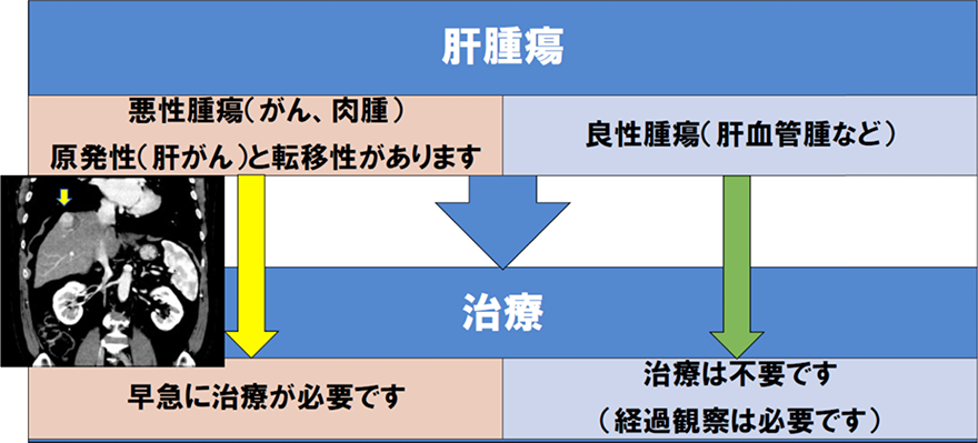 悪性腫瘍（がん，肉腫），原発性（肝がん）と転移性があります→早急に治療が必要です。良性腫瘍（肝血管種など）→治療は不要です。（経過観察は必要です）