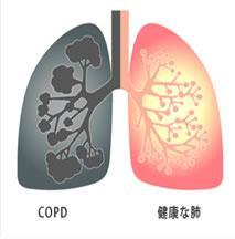 *慢性閉塞性肺疾患(COPD)の肺と健康な肺