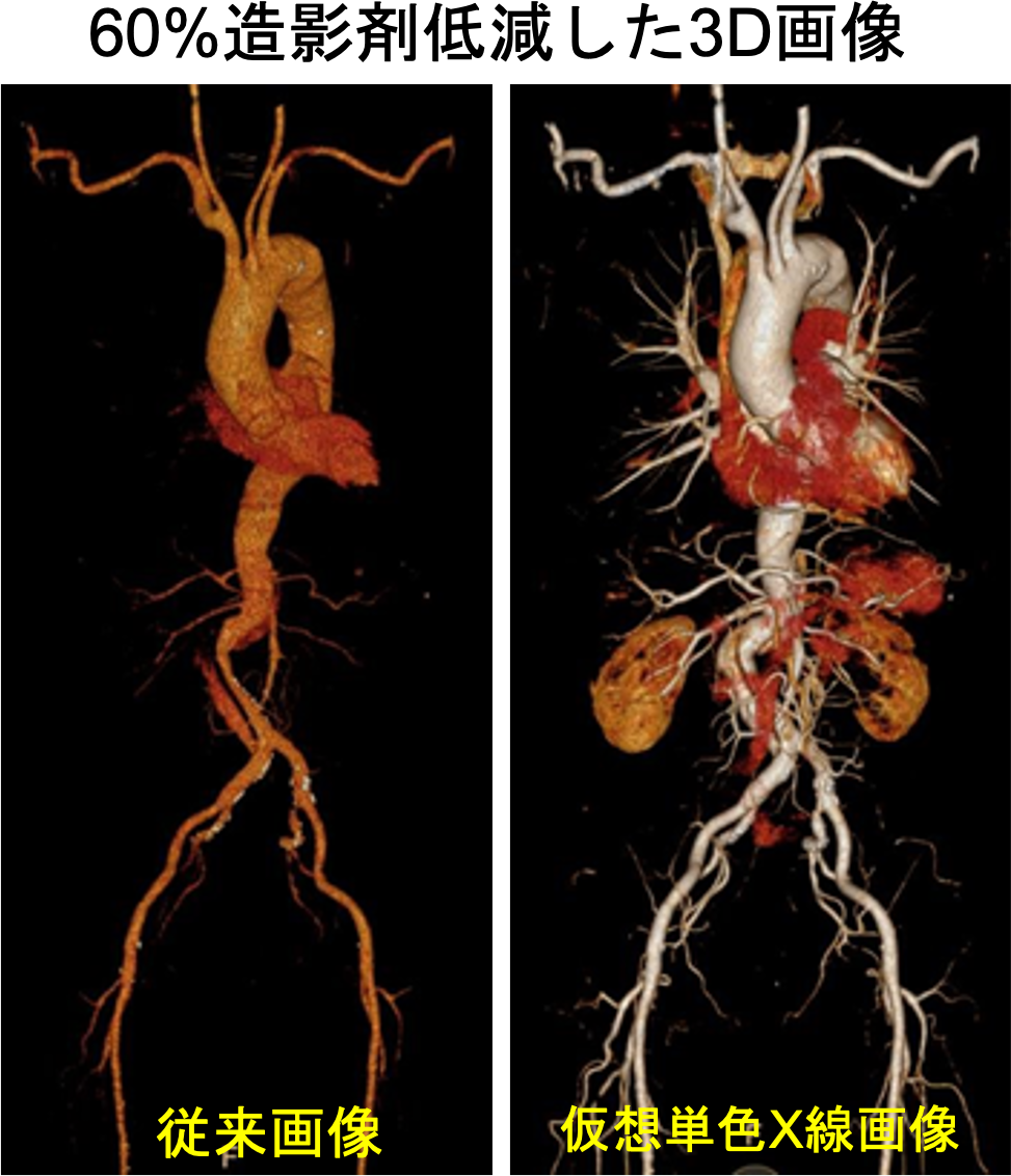 60%造影剤低減した3D画像