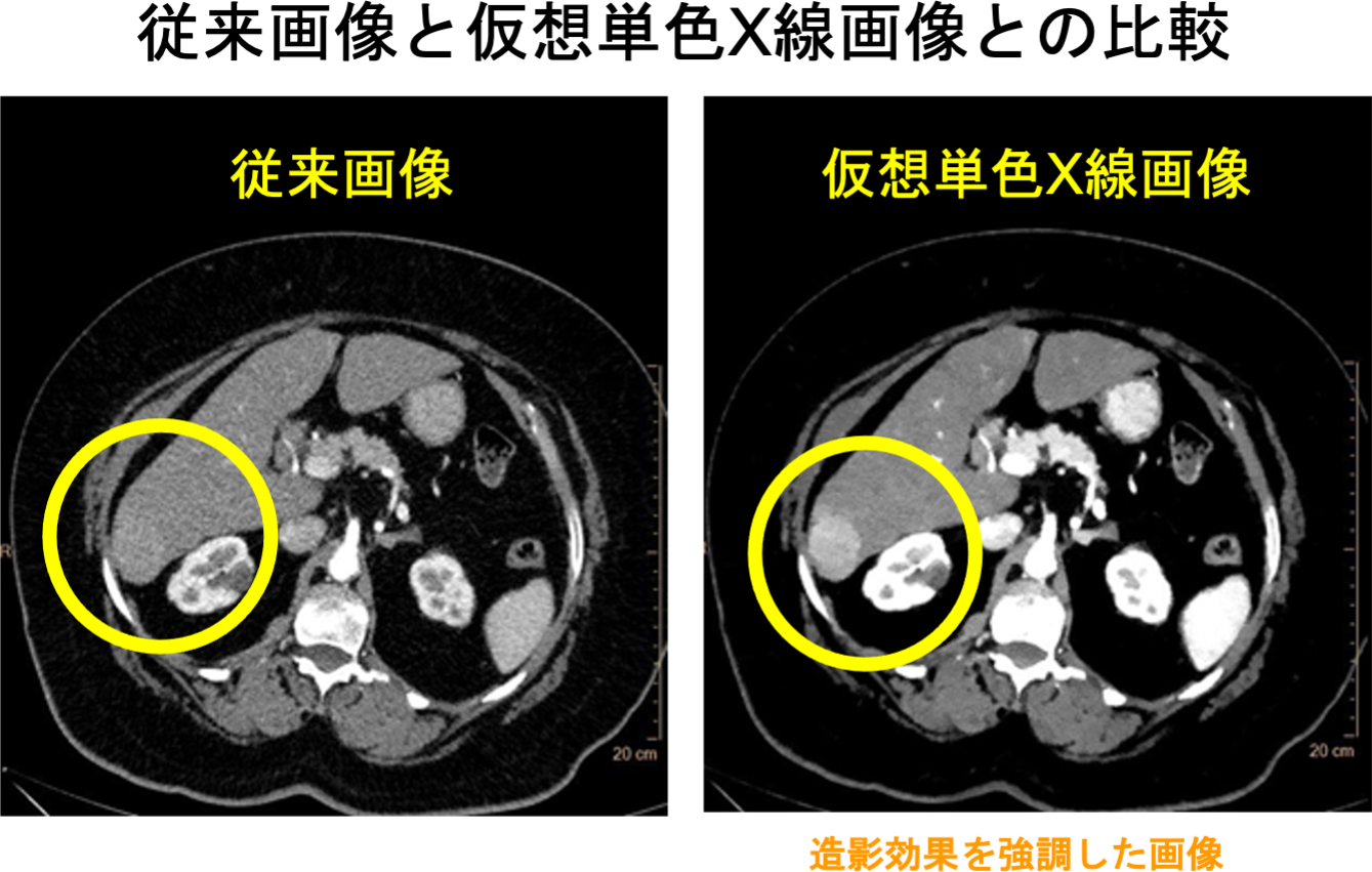 従来画像と仮想単色X線画像との比較