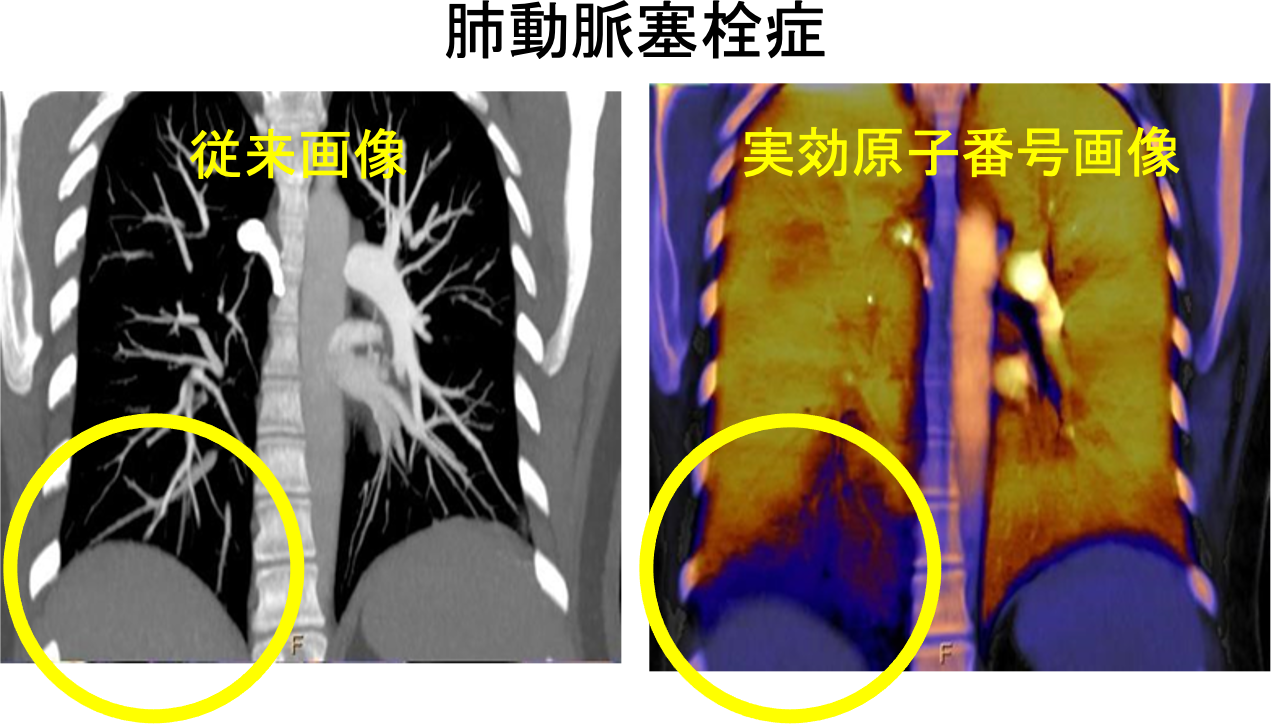 肺動脈塞栓症