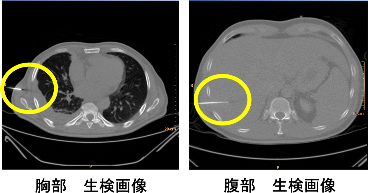 CTガイド下生検