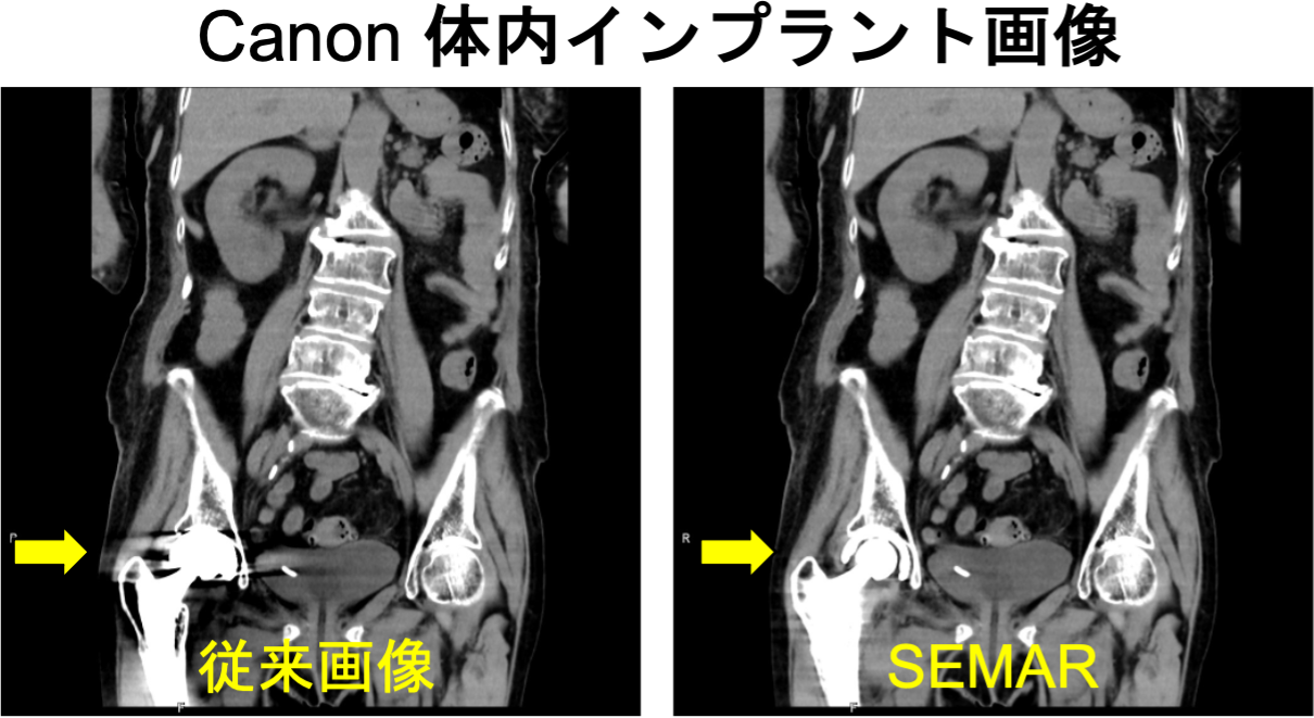Canon 体内インプラント画像