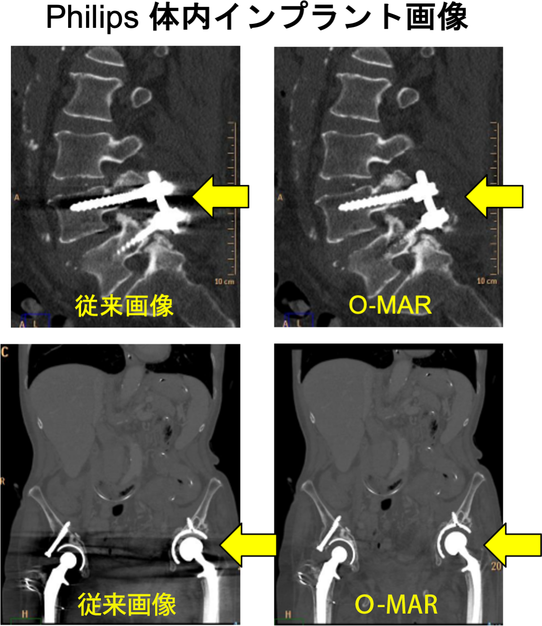 Philips 体内インプラント画像