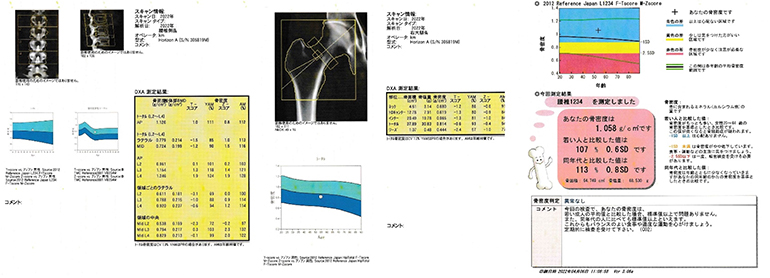 骨密度測定結果