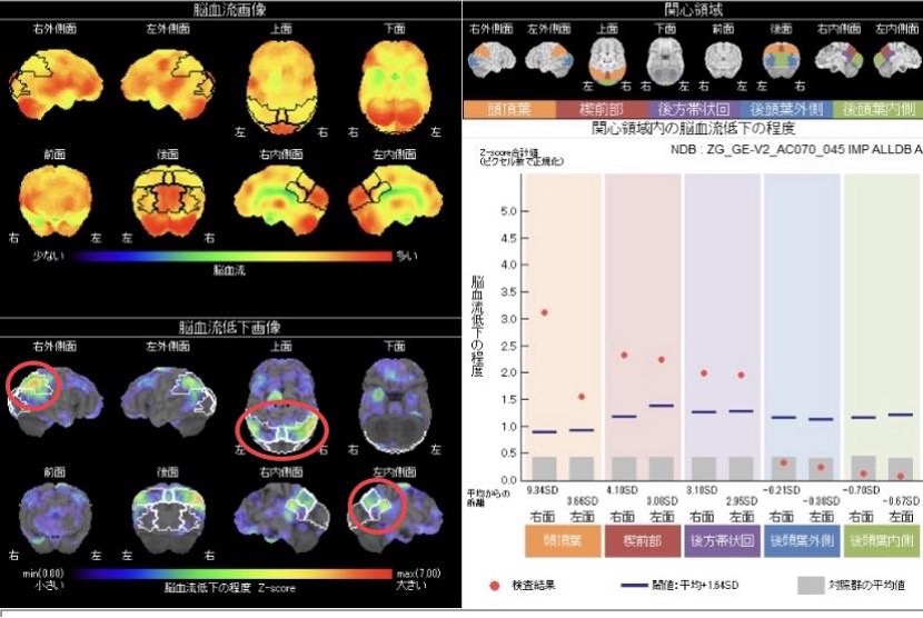 脳血流SPECT検査解析結果