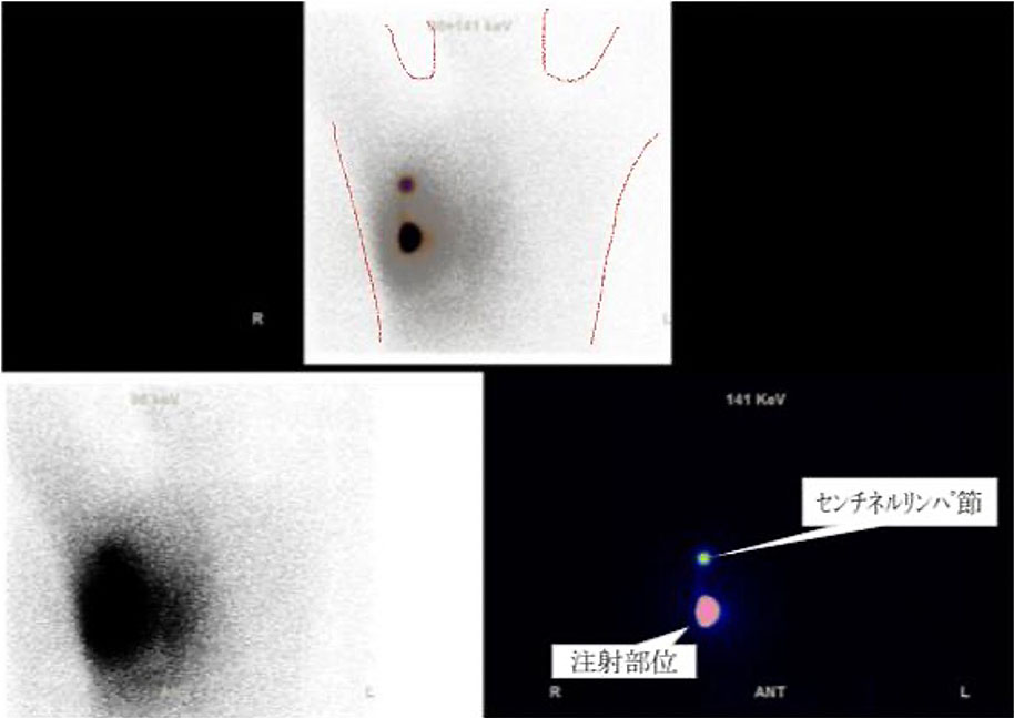 センチネルリンパ節シンチグラフィ