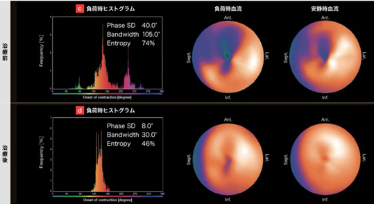 左心室のSPECT画像