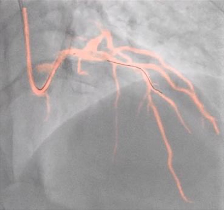 Dynamic Coronary Roadmap