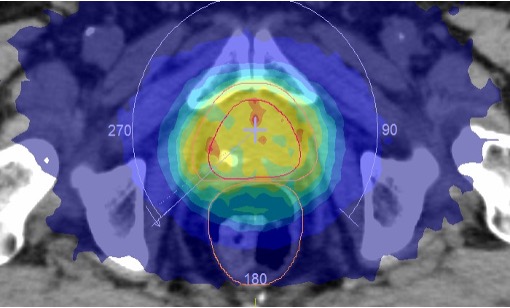 前立腺癌に対する三次元原体照射による線量分布