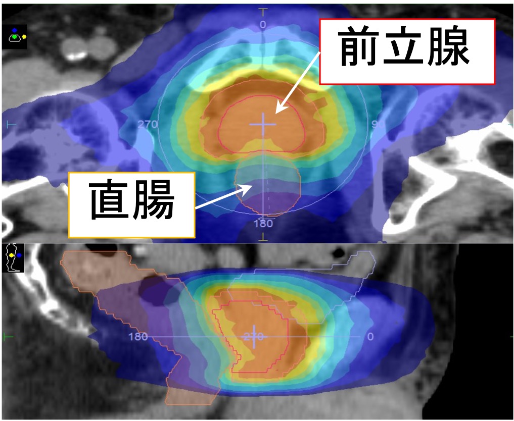 前立腺癌に対するIMRTによる線量分布