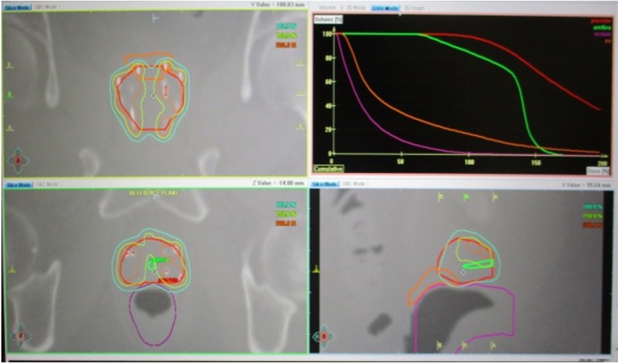 前立腺癌に対する組織内照射