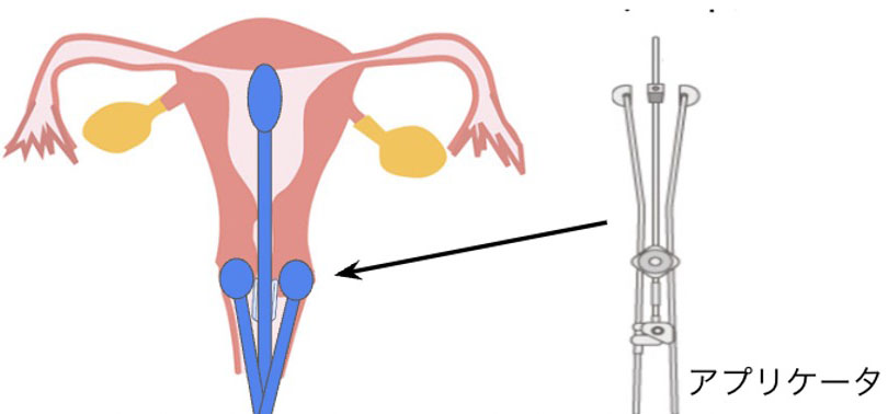 膣腔内にアプリケータを挿入し放射線治療を行う