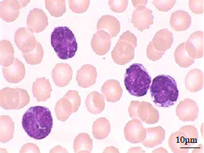 *末梢血液像（成人T細胞白血病細胞）