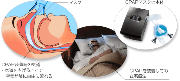 CPAP装着時の気道
・気道を広げることで空気が肺に自由に流れる
CPAPを装着した就寝
CPAPマスクと本体