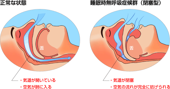 
正常な状態
・気道が開いている
・空気が肺に自由に流れる
睡眠時無呼吸症候群
・気道が閉塞
・空気の流れが妨げられる